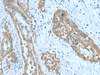 Immunohistochemistry of paraffin-embedded Human thyroid cancer tissue  using SRPK2 Polyclonal Antibody at dilution of 1:90(×200)