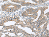 Immunohistochemistry of paraffin-embedded Human colorectal cancer tissue  using DPY19L3 Polyclonal Antibody at dilution of 1:120(×200)