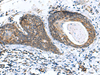 Immunohistochemistry of paraffin-embedded Human esophagus cancer tissue  using AP1S3 Polyclonal Antibody at dilution of 1:70(×200)