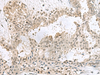 Immunohistochemistry of paraffin-embedded Human breast cancer tissue  using PCBD1 Polyclonal Antibody at dilution of 1:60(×200)