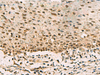 Immunohistochemistry of paraffin-embedded Human cervical cancer tissue  using PHF5A Polyclonal Antibody at dilution of 1:90(×200)
