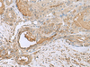 Immunohistochemistry of paraffin-embedded Human thyroid cancer tissue  using GABARAPL2 Polyclonal Antibody at dilution of 1:55(×200)