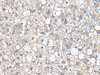 Immunohistochemistry of paraffin-embedded Human liver cancer tissue  using RHBDL2 Polyclonal Antibody at dilution of 1:110(×200)