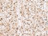 Immunohistochemistry of paraffin-embedded Human liver cancer tissue  using RPL35 Polyclonal Antibody at dilution of 1:70(×200)
