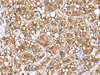 Immunohistochemistry of paraffin-embedded Human liver cancer tissue  using PHLDA3 Polyclonal Antibody at dilution of 1:110(×200)