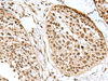 Immunohistochemistry of paraffin-embedded Human esophagus cancer tissue  using H2AFJ Polyclonal Antibody at dilution of 1:170(×200)