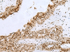 Immunohistochemistry of paraffin-embedded Human breast cancer tissue  using H2AFJ Polyclonal Antibody at dilution of 1:170(×200)