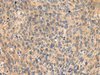 Immunohistochemistry of paraffin-embedded Human cervical cancer tissue  using MIA Polyclonal Antibody at dilution of 1:100(×200)