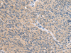 Immunohistochemistry of paraffin-embedded Human cervical cancer tissue  using FAM19A4 Polyclonal Antibody at dilution of 1:55(×200)