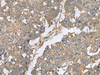 Immunohistochemistry of paraffin-embedded Human liver cancer tissue  using EIF1AX Polyclonal Antibody at dilution of 1:65(×200)