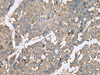 Immunohistochemistry of paraffin-embedded Human liver cancer tissue  using PLA2G2A Polyclonal Antibody at dilution of 1:50(×200)