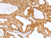 Immunohistochemistry of paraffin-embedded Human thyroid cancer tissue  using RPS16 Polyclonal Antibody at dilution of 1:60(×200)