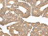 Immunohistochemistry of paraffin-embedded Human colorectal cancer tissue  using AHNAK Polyclonal Antibody at dilution of 1:50(×200)