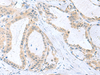 Immunohistochemistry of paraffin-embedded Human thyroid cancer tissue  using PDE6D Polyclonal Antibody at dilution of 1:50(×200)