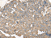 Immunohistochemistry of paraffin-embedded Human liver cancer tissue  using RPS14 Polyclonal Antibody at dilution of 1:50(×200)