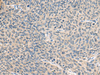 Immunohistochemistry of paraffin-embedded Human cervical cancer tissue  using RNASE1 Polyclonal Antibody at dilution of 1:50(×200)