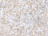 Immunohistochemistry of paraffin-embedded Human liver cancer tissue  using CGB5 Polyclonal Antibody at dilution of 1:55(×200)