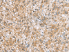 Immunohistochemistry of paraffin-embedded Human liver cancer tissue  using DNPH1 Polyclonal Antibody at dilution of 1:60(×200)