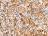 Immunohistochemistry of paraffin-embedded Human liver cancer tissue  using NMU Polyclonal Antibody at dilution of 1:80(×200)