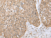 Immunohistochemistry of paraffin-embedded Human esophagus cancer tissue  using EIF4A2 Polyclonal Antibody at dilution of 1:65(×200)