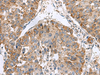 Immunohistochemistry of paraffin-embedded Human liver cancer tissue  using NFS1 Polyclonal Antibody at dilution of 1:50(×200)