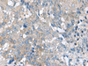 Immunohistochemistry of paraffin-embedded Human liver cancer tissue  using HPCAL1 Polyclonal Antibody at dilution of 1:70(×200)