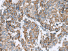 Immunohistochemistry of paraffin-embedded Human liver cancer tissue  using PRELID3B Polyclonal Antibody at dilution of 1:90(×200)