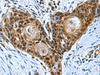 Immunohistochemistry of paraffin-embedded Human esophagus cancer tissue  using ITGB1BP1 Polyclonal Antibody at dilution of 1:50(×200)