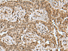 Immunohistochemistry of paraffin-embedded Human ovarian cancer tissue  using BCL7B Polyclonal Antibody at dilution of 1:85(×200)