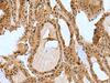 Immunohistochemistry of paraffin-embedded Human thyroid cancer tissue  using BCL7B Polyclonal Antibody at dilution of 1:85(×200)