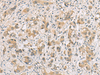 Immunohistochemistry of paraffin-embedded Human liver cancer tissue  using RTP4 Polyclonal Antibody at dilution of 1:80(×200)