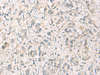 Immunohistochemistry of paraffin-embedded Human liver cancer tissue  using STX6 Polyclonal Antibody at dilution of 1:60(×200)