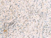 Immunohistochemistry of paraffin-embedded Human liver cancer tissue  using SUSD3 Polyclonal Antibody at dilution of 1:95(×200)