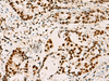 Immunohistochemistry of paraffin-embedded Human cervical cancer tissue  using ELF5 Polyclonal Antibody at dilution of 1:70(×200)
