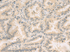 Immunohistochemistry of paraffin-embedded Human lung cancer tissue  using HHIPL2 Polyclonal Antibody at dilution of 1:55(×200)