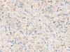 Immunohistochemistry of paraffin-embedded Human liver cancer tissue  using WDR37 Polyclonal Antibody at dilution of 1:50(×200)