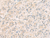 Immunohistochemistry of paraffin-embedded Human liver cancer tissue  using THG1L Polyclonal Antibody at dilution of 1:70(×200)