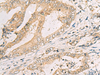 Immunohistochemistry of paraffin-embedded Human cervical cancer tissue  using SPACA1 Polyclonal Antibody at dilution of 1:50(×200)