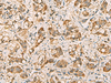 Immunohistochemistry of paraffin-embedded Human liver cancer tissue  using VTA1 Polyclonal Antibody at dilution of 1:60(×200)