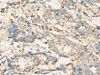 Immunohistochemistry of paraffin-embedded Human cervical cancer tissue  using VTA1 Polyclonal Antibody at dilution of 1:60(×200)