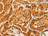 Immunohistochemistry of paraffin-embedded Human thyroid cancer tissue  using SAP30BP Polyclonal Antibody at dilution of 1:40(×200)