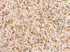 Immunohistochemistry of paraffin-embedded Human liver cancer tissue  using PDXK Polyclonal Antibody at dilution of 1:75(×200)