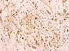 Immunohistochemistry of paraffin-embedded Human gastric cancer tissue  using SGTA Polyclonal Antibody at dilution of 1:75(×200)