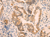 Immunohistochemistry of paraffin-embedded Human cervical cancer tissue  using CRYM Polyclonal Antibody at dilution of 1:65(×200)