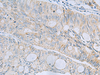 Immunohistochemistry of paraffin-embedded Human colorectal cancer tissue  using MSI2 Polyclonal Antibody at dilution of 1:60(×200)