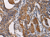 Immunohistochemistry of paraffin-embedded Human esophagus cancer tissue  using SSH3 Polyclonal Antibody at dilution of 1:60(×200)
