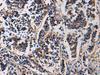 Immunohistochemistry of paraffin-embedded Human breast cancer tissue  using SSH3 Polyclonal Antibody at dilution of 1:60(×200)