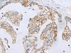 Immunohistochemistry of paraffin-embedded Human gastric cancer tissue  using MGME1 Polyclonal Antibody at dilution of 1:70(×200)