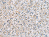 Immunohistochemistry of paraffin-embedded Human liver cancer tissue  using MTHFD2 Polyclonal Antibody at dilution of 1:65(×200)