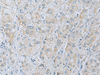 Immunohistochemistry of paraffin-embedded Human liver cancer tissue  using NAGK Polyclonal Antibody at dilution of 1:35(×200)